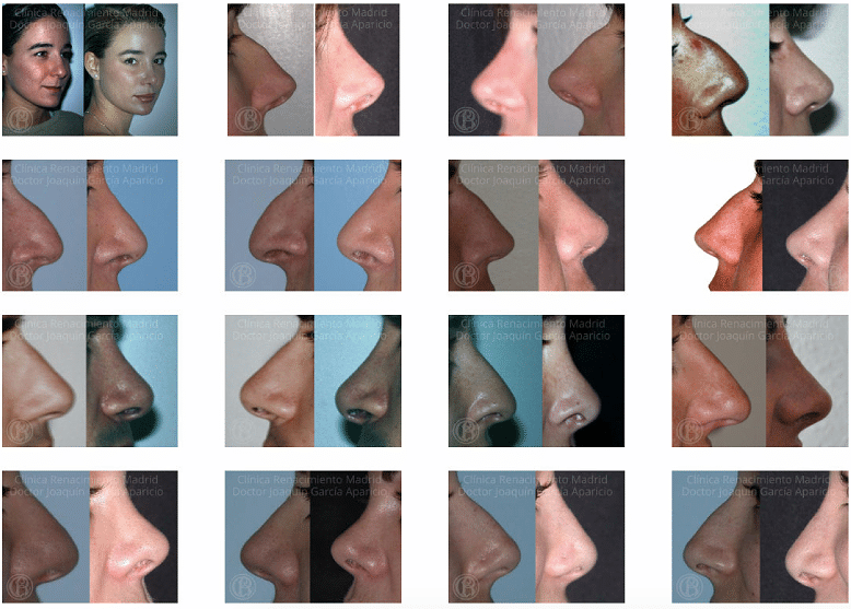 imagen de Casos reales antes y despues cirugia de nariz rinoplastia clinica renacimiento madrid
