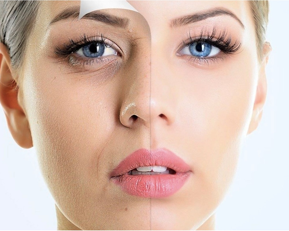 imagen de plasma gel renacimiento madrid y marbella estetica facial